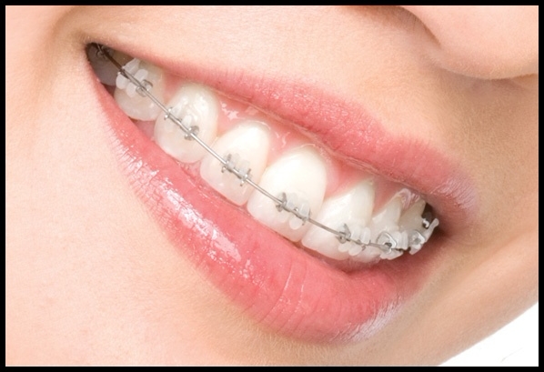 Ортодонтия: в переводе с греческого – ровные зубы!